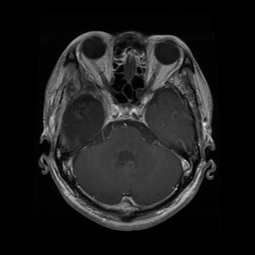 Glioma