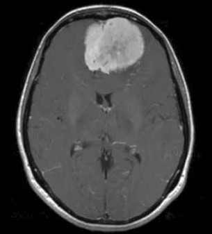 Meningioma