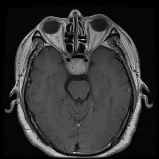 Brain Scan Analysis
